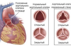 Stentul indicațiilor vaselor inimii, reabilitarea postoperatorie (video)