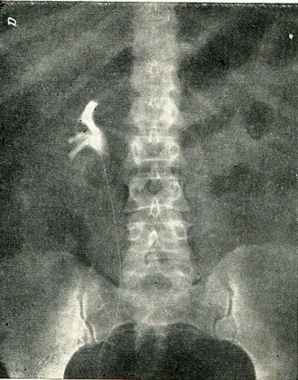 Tratamentul insuficienței renale (nefroptoză), urologie