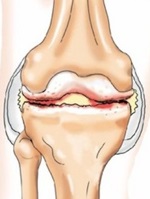 Osteopatie cu artroză la Moscova