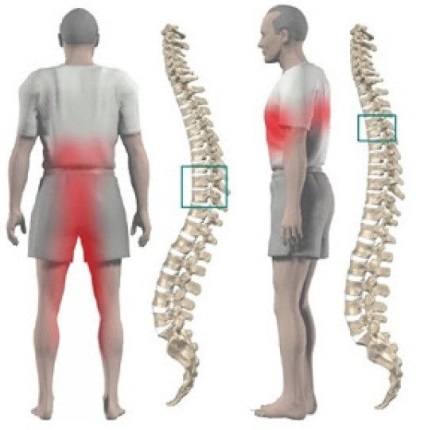 Osteochondroza coloanei vertebrale toracice și lombare, simptome și exerciții