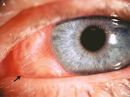 Paraziták az emberi szem okai, tünetei, diagnózis, kezelés, megelőzés