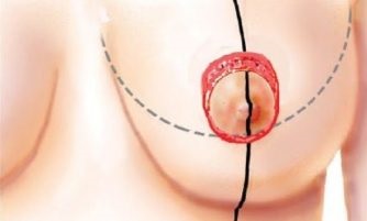 Ridicarea sânilor este procedura și reabilitarea
