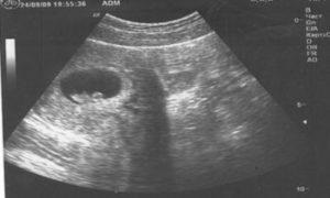 Consecințele hematomului retrochororial pentru un copil în timpul sarcinii, diagnosticului și tratamentului