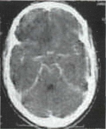 Meningita post-traumatică și meningoencefalita