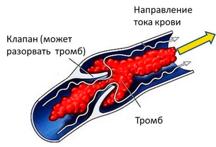 Medicamente pentru tratamentul caracteristicilor de tromboză și prevenirea bolilor