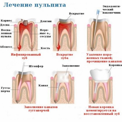 Причини за възникване на пулпит под печат и как да се отнасяме