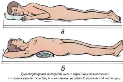 La o fractură a coloanei vertebrale, este necesar să se facă primul ajutor, fixarea, imobilizarea