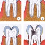 Curățarea profesională a dinților ultrasonici de la o piatră la dentist, curățarea dinților cu sifon