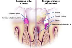 Prosthodontică pentru boala parodontală