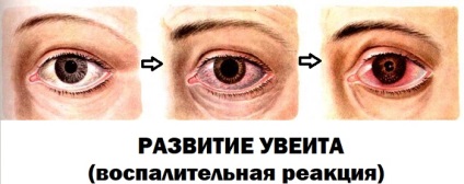 Picături antivirale pentru ochi, antibacteriene, copii, unguent, oftalmferon, cu
