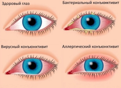 Picături antivirale pentru ochi, antibacteriene, copii, unguent, oftalmferon, cu