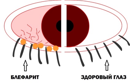 Picături antivirale pentru ochi, antibacteriene, copii, unguent, oftalmferon, cu