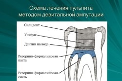 Pulpită a complicațiilor și consecințelor dintelui