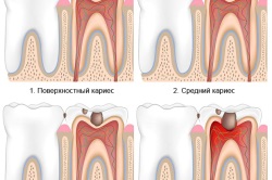 Pulpită a complicațiilor și consecințelor dintelui