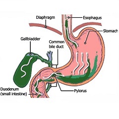 Reflux - tratament, tipuri, cauze, simptome, complicații