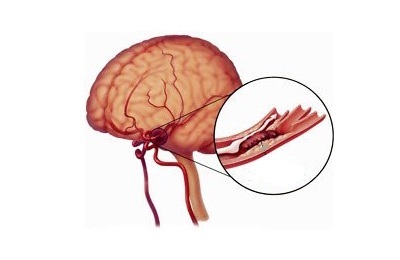 Scleroza simptomelor vaselor cerebrale, tratamentul și semnele modificărilor sclerotice