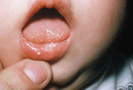Stomatitis - szájgyulladás kezelésére otthon népi jogorvoslati