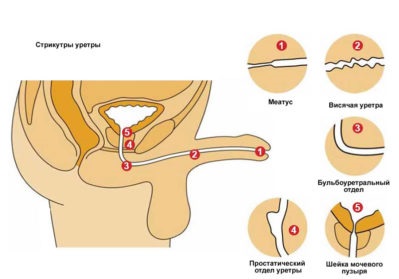 Stricturile de uretră | Dr. Marcel Rad