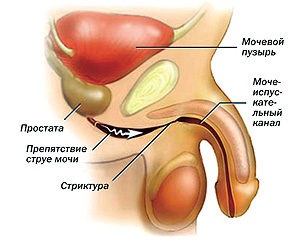 stenoza uretrala)