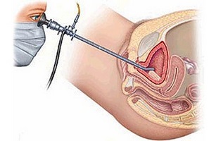 Lumanari Dicluberl cu prostatita rapidă a simptomelor