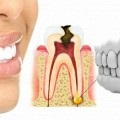 Fistula pe tratamentul gingiilor la domiciliu