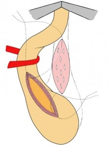 Urethroplasty - műtét húgycső szűkület, Központi Klinikai Kórház № 1, Moszkva helyszínen