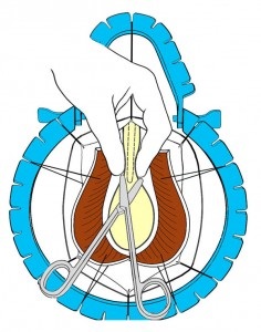 Urethroplasty - chirurgie de strictura uretra, Spitalul Clinic Central nr. 1, site-ul Moscovei