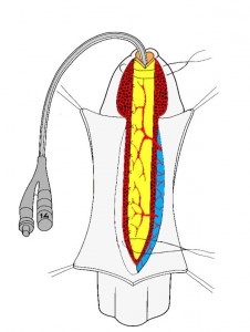 Urethroplasty - chirurgie de strictura uretra, Spitalul Clinic Central nr. 1, site-ul Moscovei