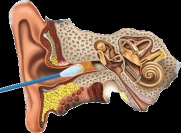 Bastoane de bumbac pentru curățarea urechilor, deoarece sunt utilizate corect