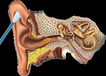 Bastoane de bumbac pentru curățarea urechilor, deoarece sunt utilizate corect