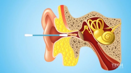 Bastoane de bumbac pentru curățarea urechilor, deoarece sunt utilizate corect