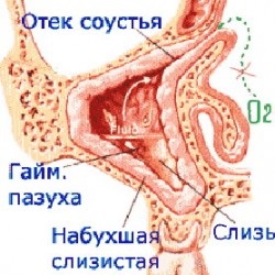 Sinuzul sinillus, sinusurile stângi și drepte, funcțiile și trăsăturile lor, totul despre sinuzită