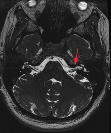 Paroxismul vestibular este centrul de gestionare a durerii al Academiei Medicale Militare