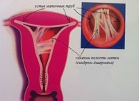 Sinechiile intrauterine - cauze de formare, manifestări clinice, tratament
