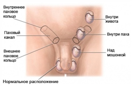 Cryptorchidism fals congenital la copii, băieți, tratament, operație