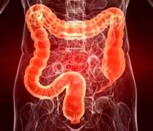 Másodlagos (visszatérő) colitis