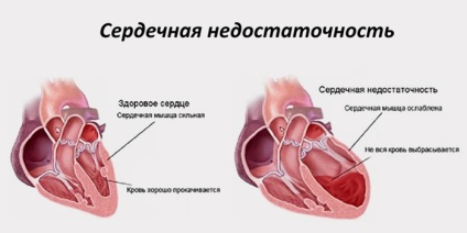 Simptome cronice de insuficiență cardiacă, etape și tratament