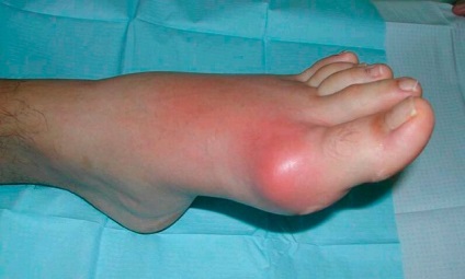 Afecțiunea artritei articulează simptomele și metodele de tratament ale bolii