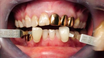 Coroane dentare de aur la Moscova, prețuri și costuri, proteze dentare, indicații și instalare,