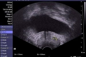 Zonele anatomiei cu ultrasunete a prostatei