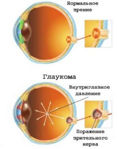 Viziune și diabet - deteriorare și pierderea vederii, simptome de apariție a dezvoltării
