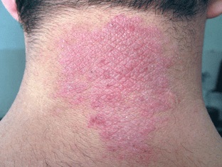 Dermatită dermatologică cum să recunoască, să trateze și să evite consecințele