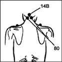 35 - Acupunctura fără ace