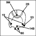 35 - Acupunctura fără ace