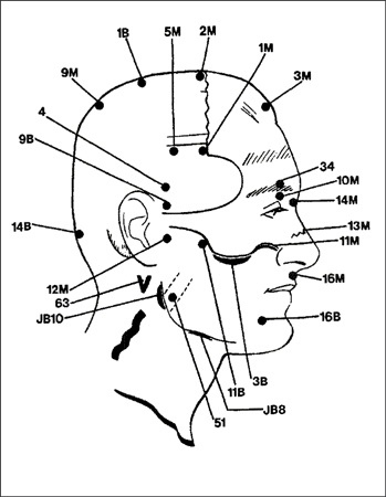 35 - Acupunctura fără ace