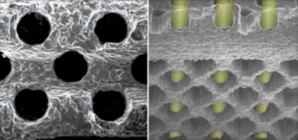 3D-nyomtatott spinális implantátum K2M támogatás a betegek a reményben, az élet fájdalom nélkül