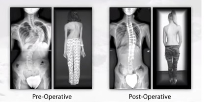 3D-nyomtatott spinális implantátum K2M támogatás a betegek a reményben, az élet fájdalom nélkül