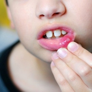 Aphthous stomatitis a gyermek okoz a betegség, a tünetek és a kezelés