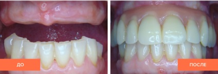 Toate pe 6 implanturi dentare pe șase implanturi