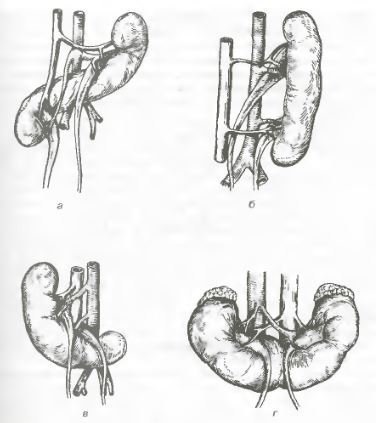 Anomalii în relația (adeziunea) rinichiului